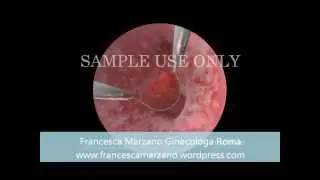 isteroscopia e infertilità femminile francesca marzano ginecologa roma