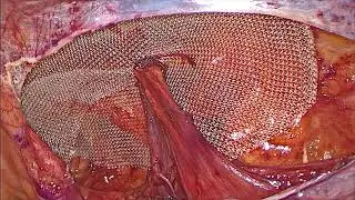 SLIT Mesh Placement in TAPP - Plastica di ernia inguinale laparoscopica
