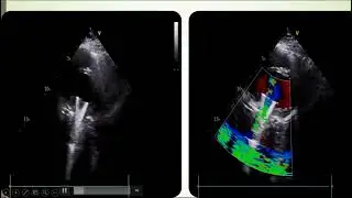 echo conference LVAD 29-5-2024