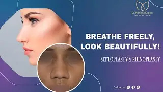 Wide Bulbous Nose Rhinoplasty | Rhinoplasty Surgery Before and After Result | Nose Surgery Result