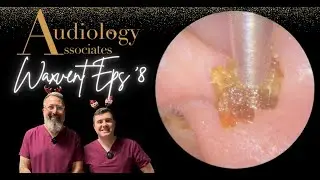 SMALL STICKY EAR WAX PLUG REMOVAL - WAXVENT 8