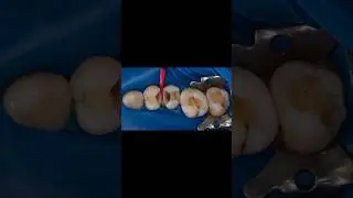 restorative journey #dentist #dentistry #toothless
