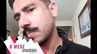 8 MESES CON MINOXIDIL KIRKLAND 5%