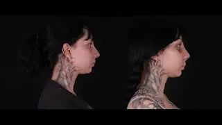 Danielle's Life-Changing Rhinoplasty Experience in Turkey