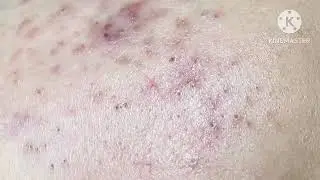 Blackheads on the girl's peeling skin (Tram P4) 