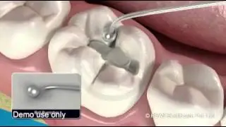 Silver Amalgam filling