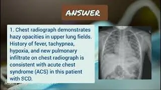 Sickle Cell Disease - Acute Chest Syndrome Case Scenario | Pediatrics Education