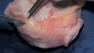 Stone Clinic Meniscus Allograft Recommendations