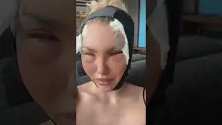 Mollie's Fox Eye Surgery Journey 
