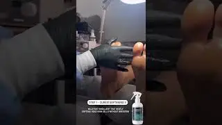CUREIX SOFTENING V