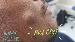 Massive Face Cyst. DR Khaled Sadek. LipomaCyst.com