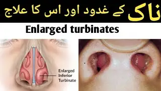 enlarged turbinates symptoms causes and treatment/nak k ghadood ka ilaj kia hai