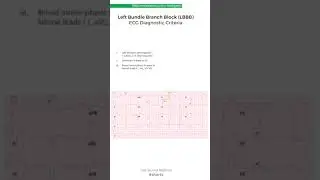 Left Bundle Branch Block (LBBB) ECG Criteria 