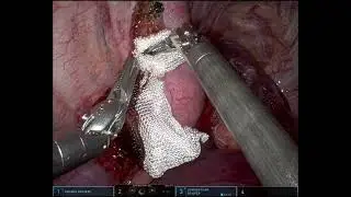 Robotic Hybrid Resection of Paraspinal Mass
