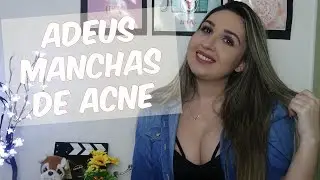 Peeling 3D - Minha Experiência