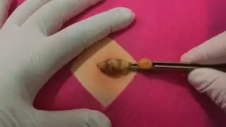 Treatment Of Blackhead Removal at Lam Dep Spa #043