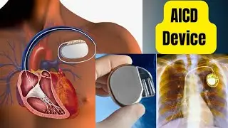 AICD Device