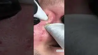 Tips for Preventing Acne Breakouts