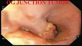 Esophago gastric junction tumor| OG junction tumor| Gastric carcinoma| Biopsy| Dr. Pandiaraja