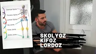 SKOLYOZ LORDOZ KİFOZ NEDİR?... DURUŞ BOZUKLUKLARI....