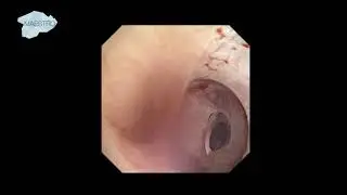 ECIRS Puncture