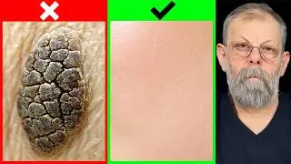 Keratomas. Causes. Home Help Point