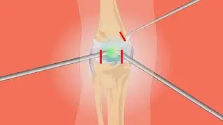 Knee Anatomy pain Animated Surgical video for medical interns
