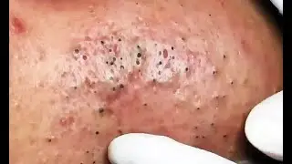 Extreme Deep Blackhead Removal - Best Blackhead Extraction Videos