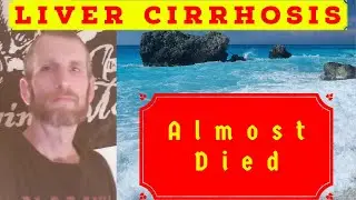 I Totally Almost Died ( Not Clickbait) Liver Cirrhosis and Esophageal Varices