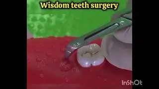 Wisdom Teeth surgery | Step by Step Process