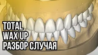 TOTAL WAX UP разбор случая