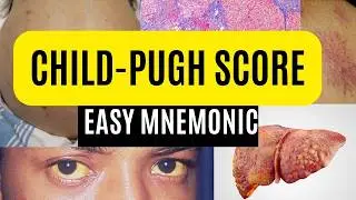 Child-Pugh Score - Easy Mnemonic