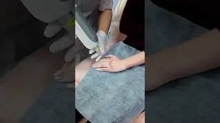 Удаление татуировок на пальцах в клинике Асклепион