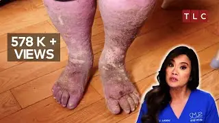 Sandra’s Fight Between Life and Death! | Dr Pimple Popper | TLC