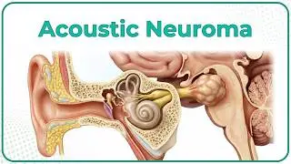 Acoustic Neuroma : ENT Lectures