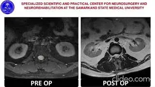 Long intradural spinal cord tumor (neuroma)on the lev. VTh12-VL1-2-3.Result of microscopic resection