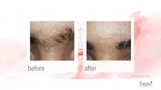 Laser Hair Removal - Frac3
