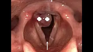 Intubation Granuloma
