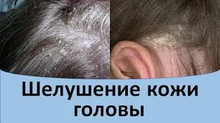 Шелушение кожи головы