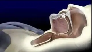 Sleep Apnea Explained By ORA Oral Surgery, Sleep Disorder & Implant Studio