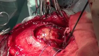 Usunięcie naczyniaka jamistego mózgu Klinika Neurochirurgii CSK MSWiA