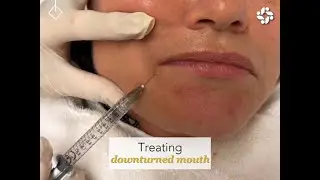 TURN THAT FROWN UPSIDE DOWN: CONQUERING A DOWNTURNED MOUTH