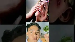 Ini jerawat jenis apa ya !