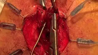 Martius’ flap repair for recurrent rectovaginal fistula