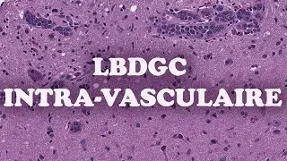 LE LYMPHOME B DIFFUS A GRANDES CELLULES INTRA-VASCULAIRE - PATHOLOGIE