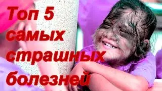 Топ 5 самых страшных болезней в мире .