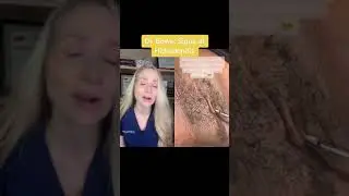 Dermatologist on the skin condition hidradenitis 