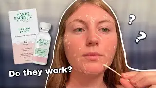 TRYING THE Mario Badescu DRYING LOTION + PATCHES | 1 week Review & Results