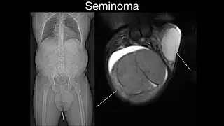 Seminoma