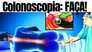 Câncer de INTESTINO: Como a colonoscopia e a retirada dos pólipos podem salvar sua vida!